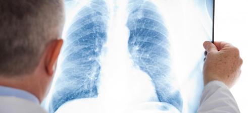 x-ray thorax chest trachea